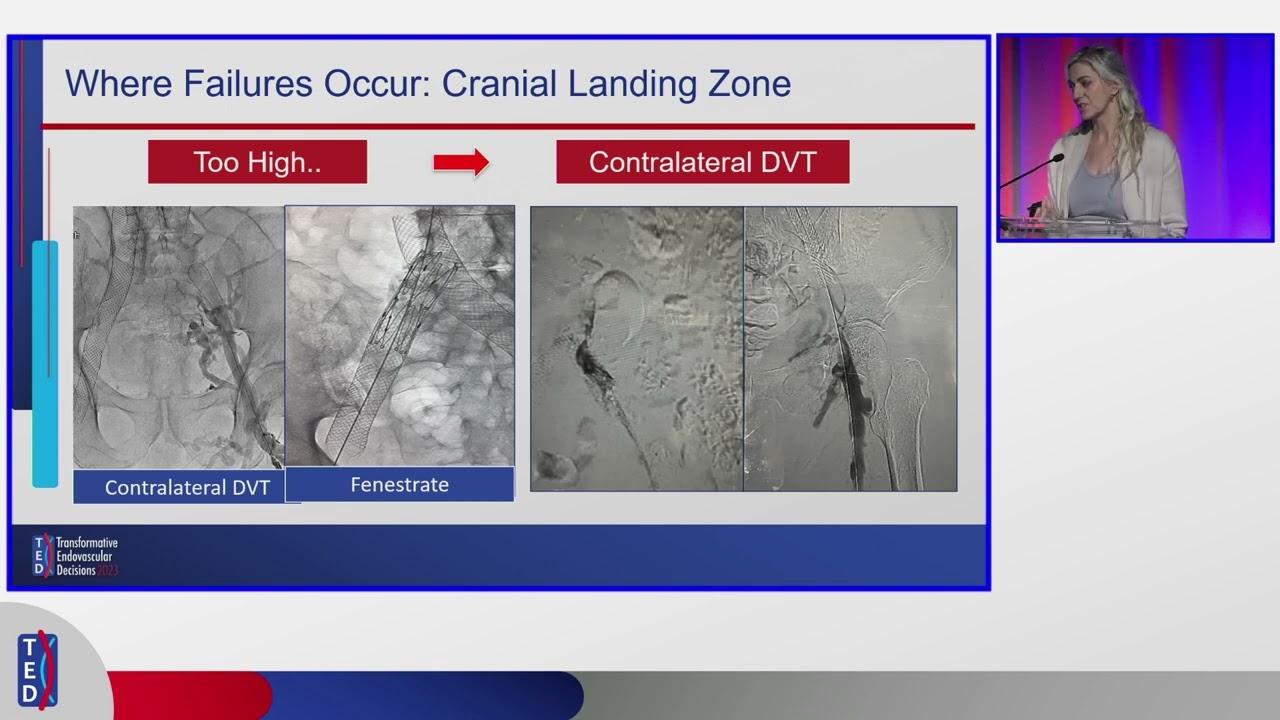 Chronic DVT & Venous Stent Failures: Stenting and Salvage Tips | Dr. Erin Murphy at TED 2025
