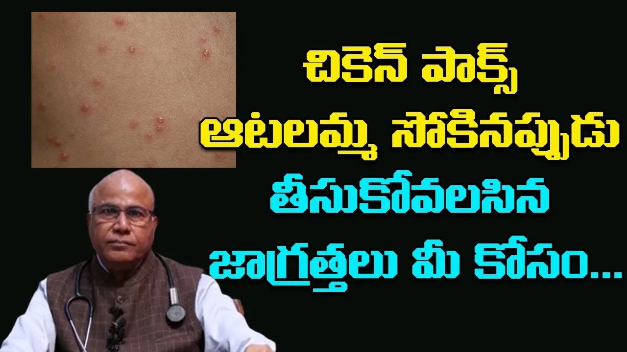 చికెన్ ఫాక్స్ ఆటలమ్మ సోకినప్పుడు తీసుకోవలసిన జాగ్రత్తలు మీ కోసం | Precautions for Chicken Pox