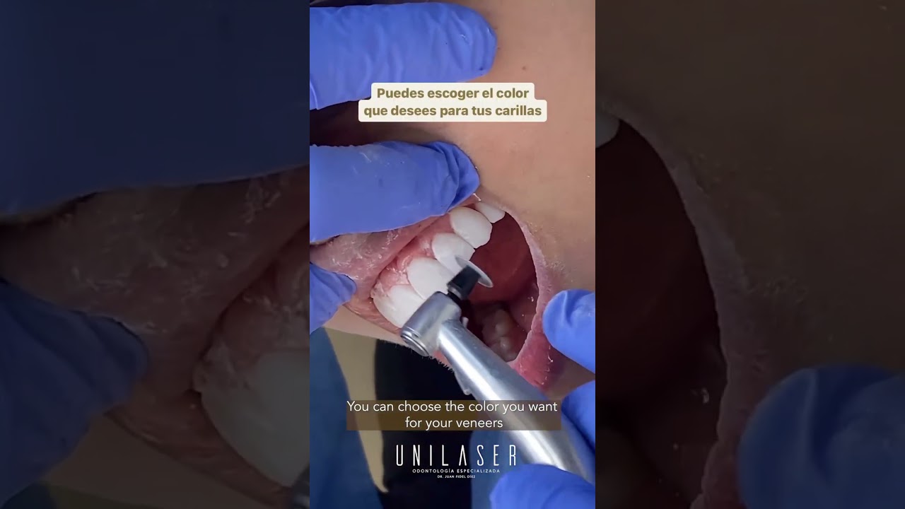 Bonding veneers | Carillas en resina