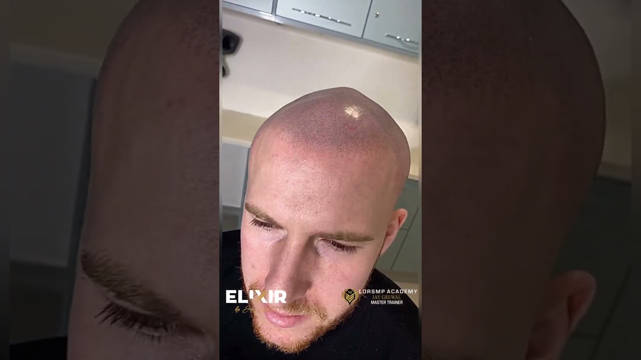 SMP hairline transformation #smp #smplondon #smpdubai #scalpmicropigmentation #smptraining