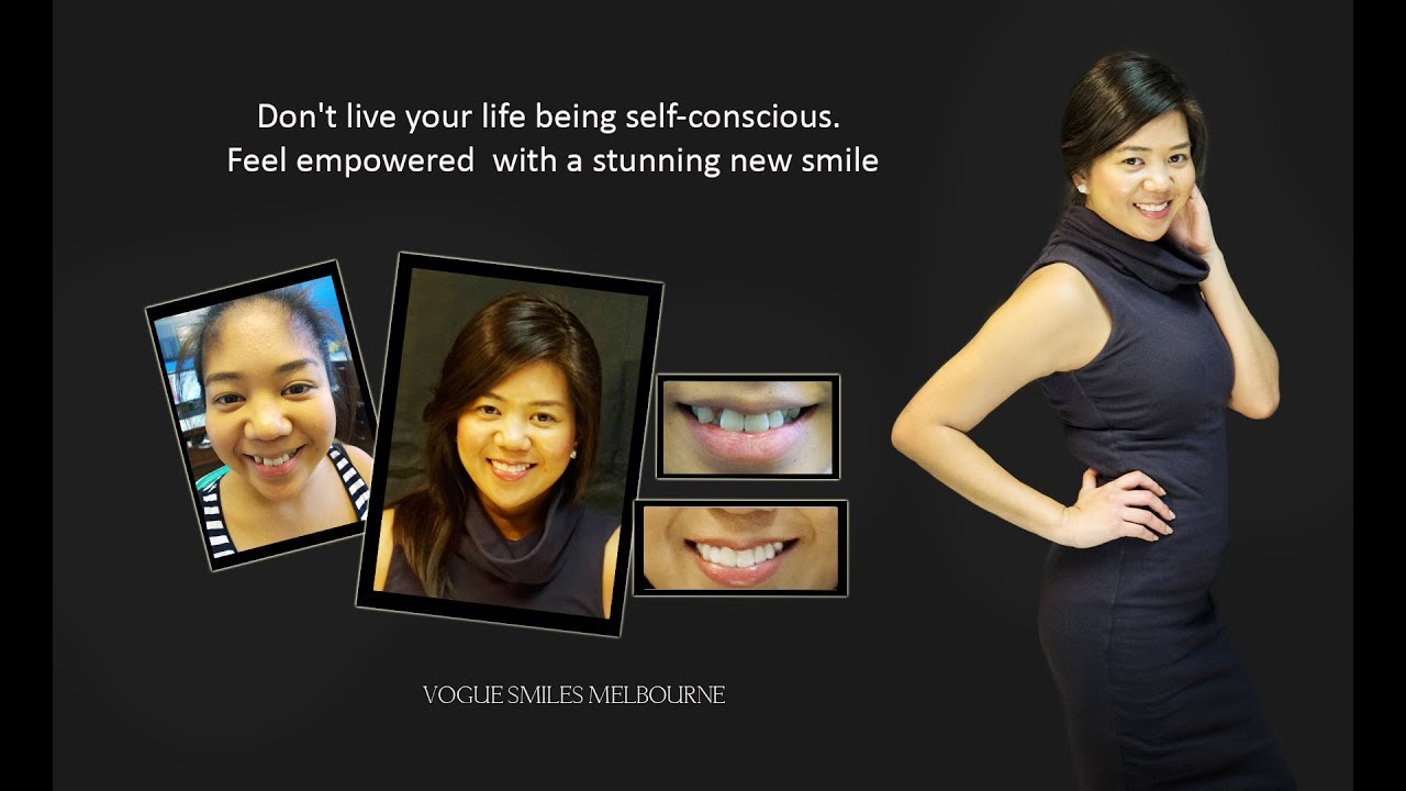 How Can You Instantly straighten Crooked Teeth without #Braces or #Invisalign? | VOGUE SMILES MELB