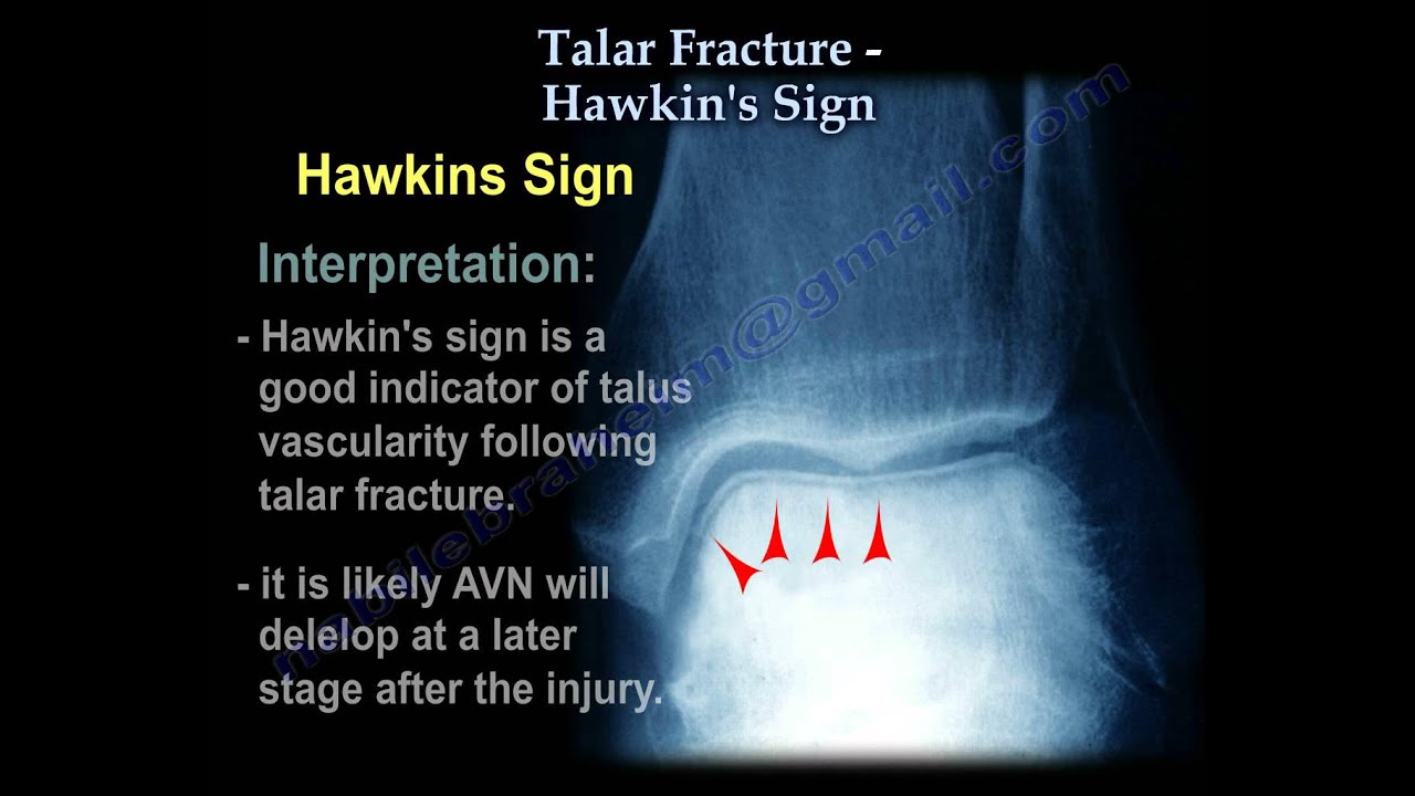Talus Fracture , Hawkin's Sign - Everything You Need To Know - Dr. Nabil Ebraheim
