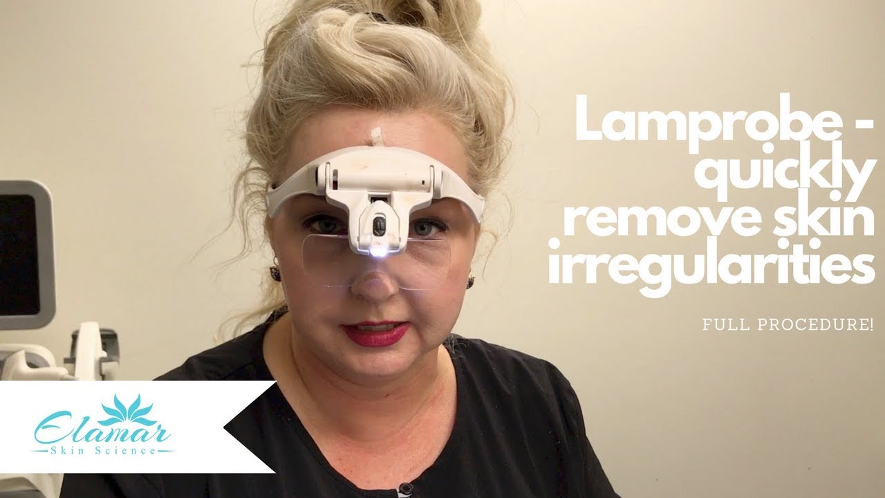 Lamprobe | Quickly and Painlessly Remove Skin Irregularities