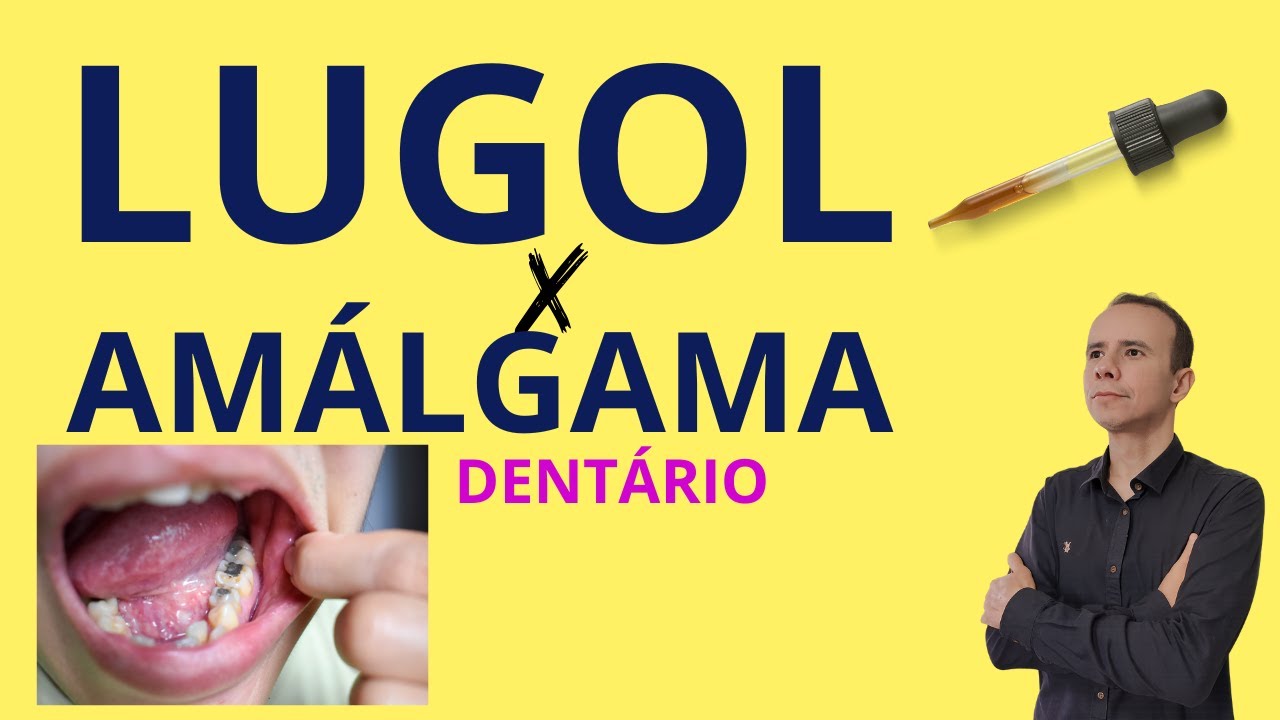 A Verdade Sobre Lugol e as Amálgamas Dentárias