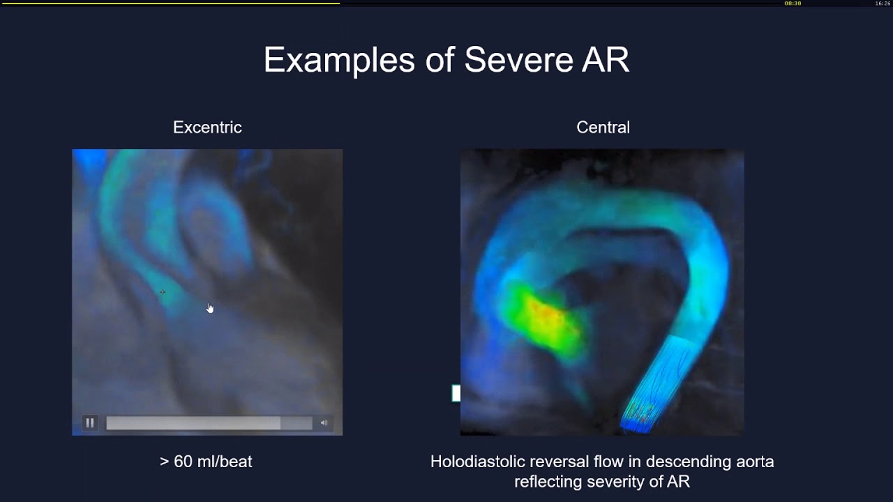 Clinical validation of 4D Flow MRI for Cardiac Valvular Disease