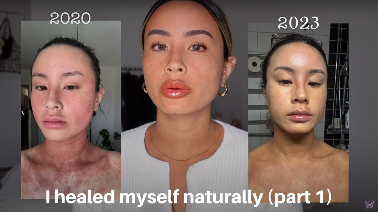 How to heal yourself naturally I part 1 (within 6 months) // TSW, Eczema