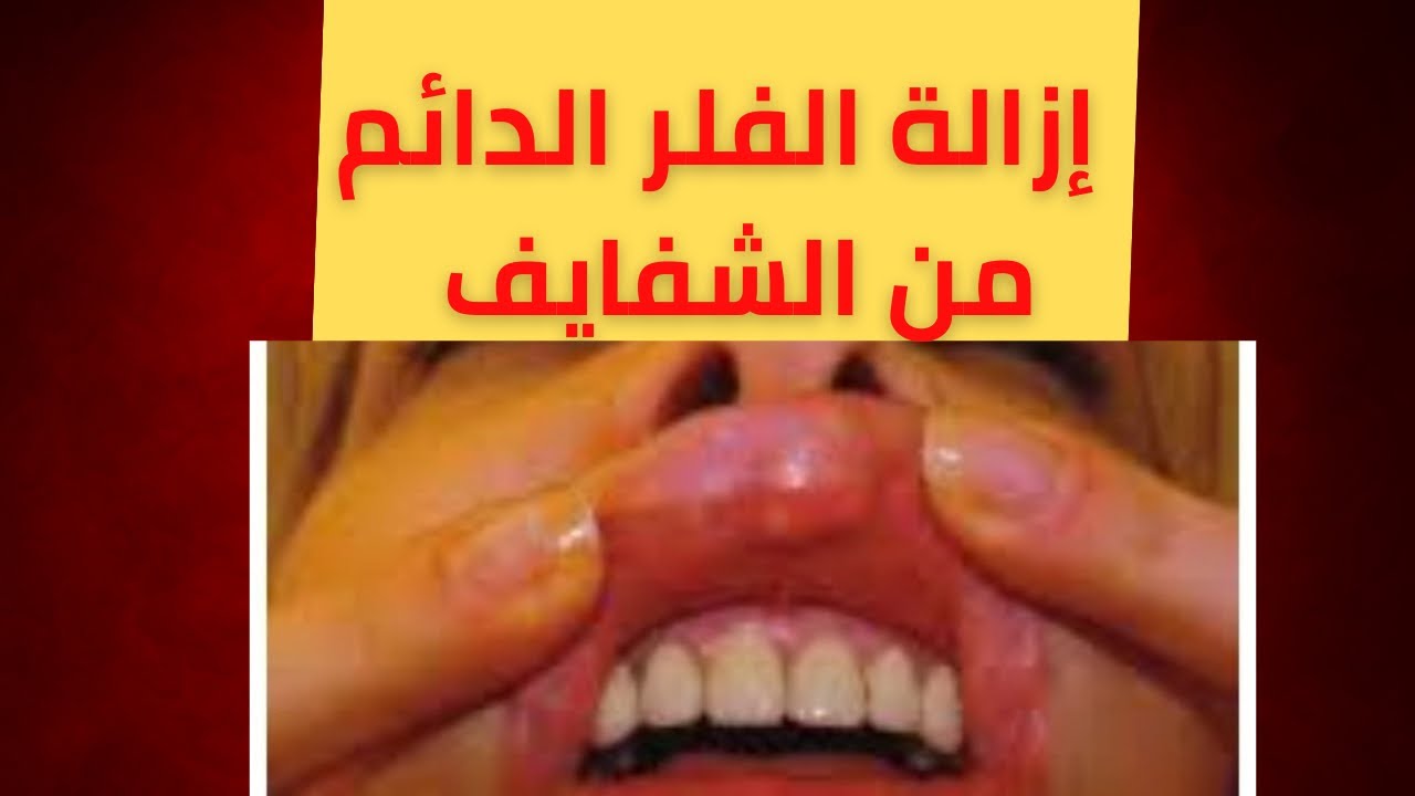 إزالة الفلر الدائم من الشفايف