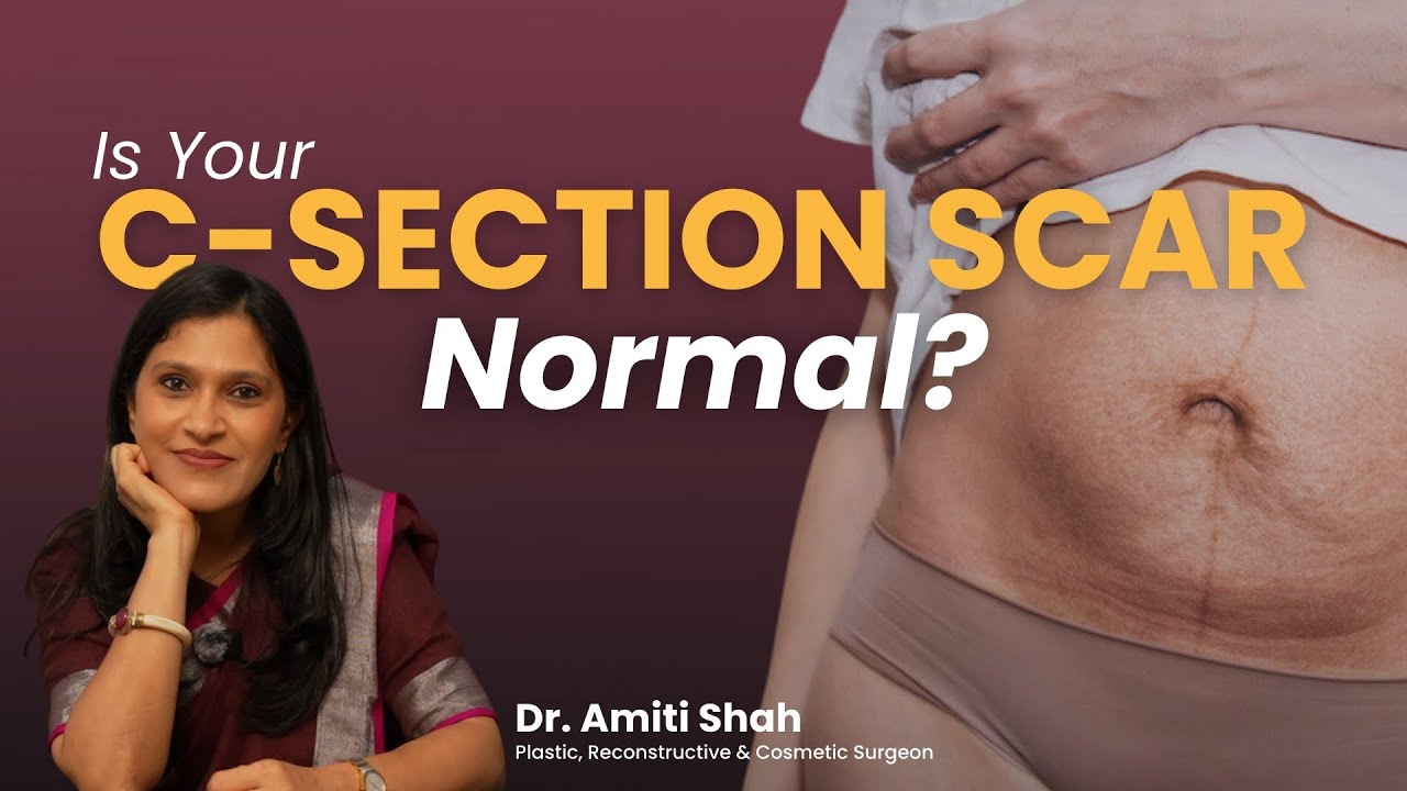 Raised or Painful C-Section Scar? | Best C‑Section Scar Removal & Treatment | Dr. Amit Shah