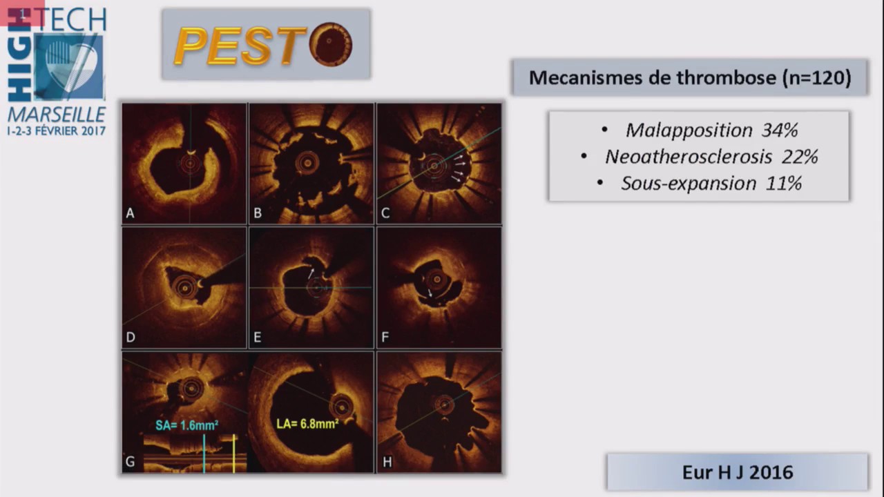 THROMBOSE DE STENT  ENCORE DACTUALITÉ