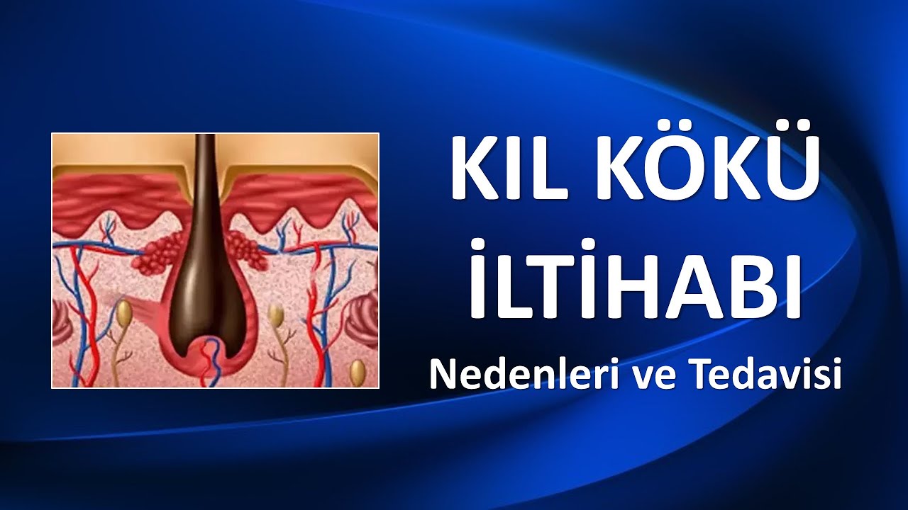 KIL KÖKÜ İLTİHABI Nedenleri ve Tedavisi