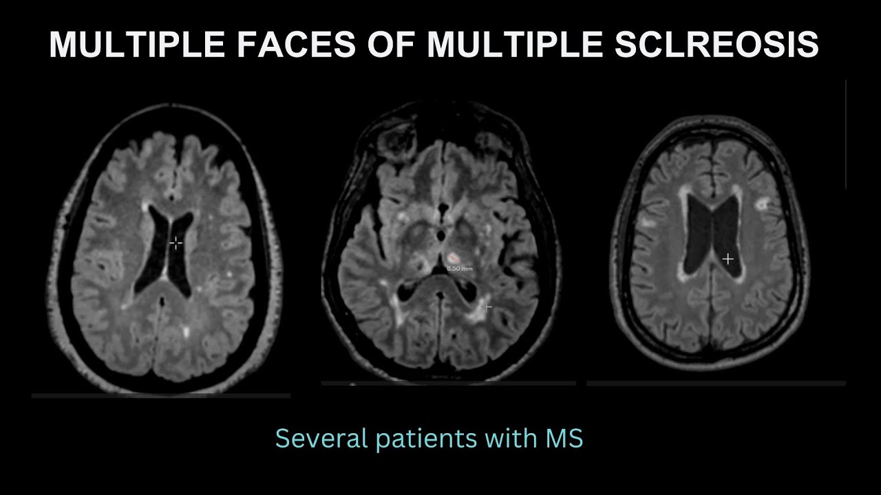 Multiple manifestations of multiple sclerosis