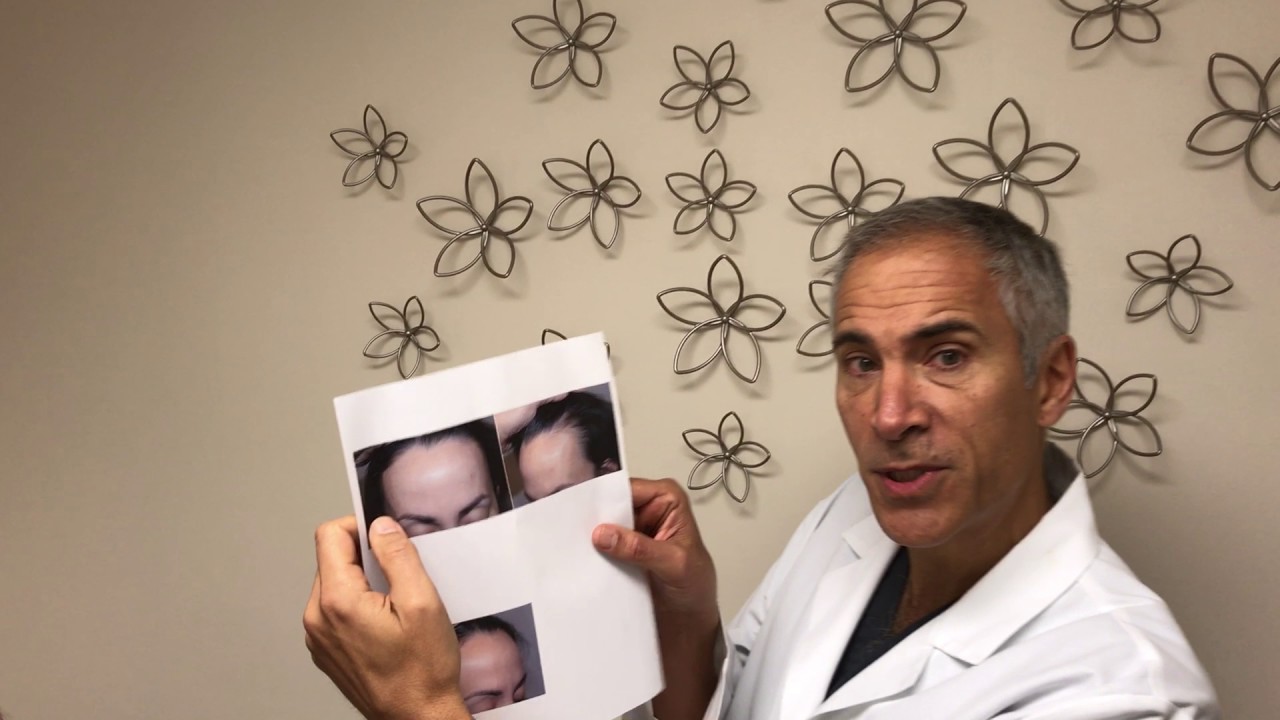 Result After Hairline Lowering/Forehead Reduction Surgery combined with Hair Grafting | Dr. Epstein