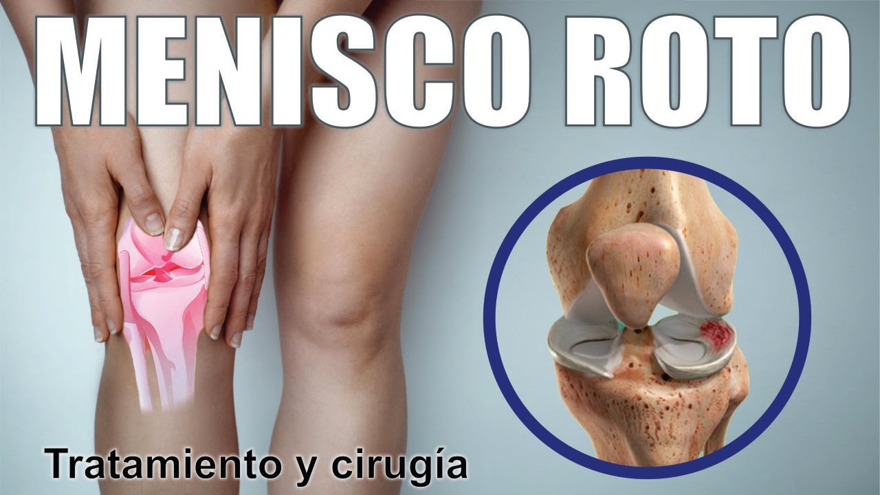 ROTURA de MENISCO 🦵🏼¿Cómo Saber Si Hay Una Lesión De Menisco? 🦵🏼 Cirugía Terapia ⭐ Dr EDSON SERRANO