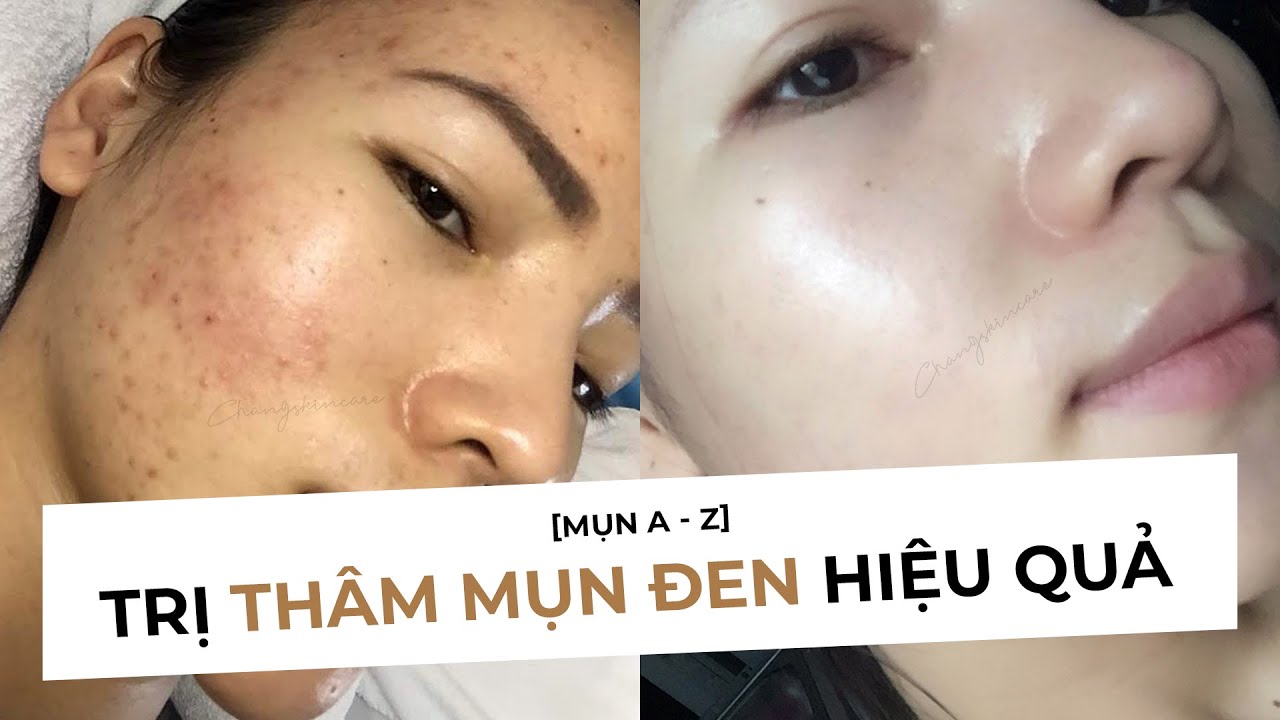 TRỊ THÂM MỤN NÂU ĐEN HIỆU QUẢ - PIH - ĐẶC BIỆT DÀNH CHO NHỮNG BẠN THÂM LÂU
