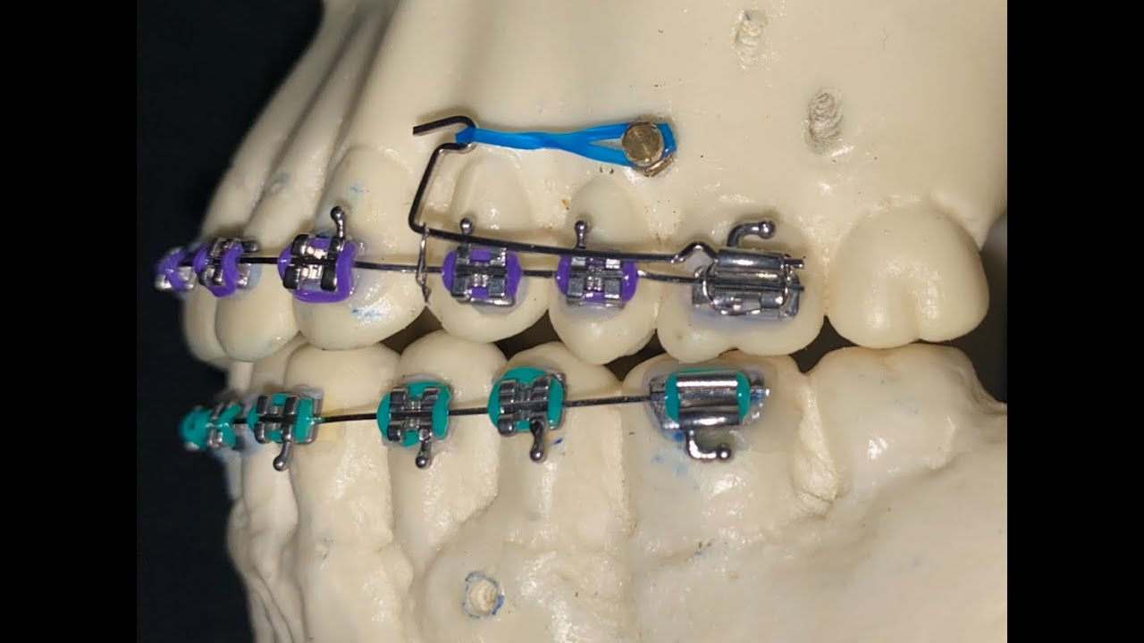Cursor Simplificado para Distalizar Molares com Mini-implantes.