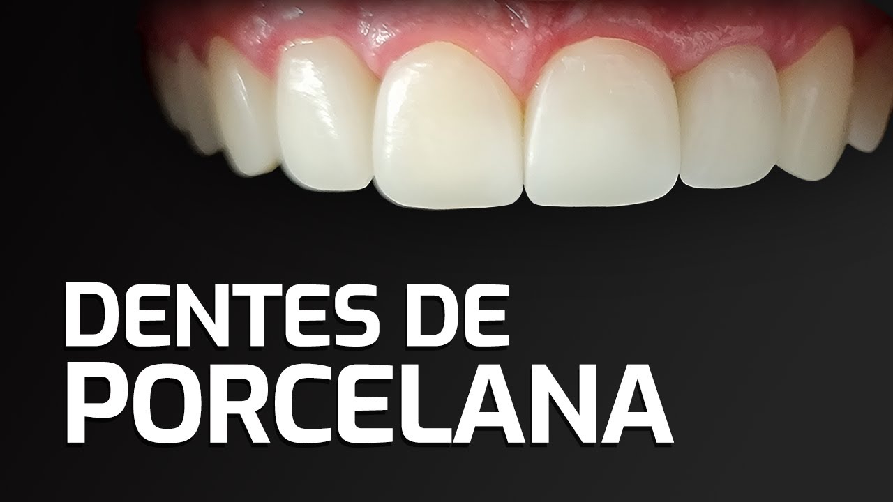 [PORCELANA ODONTOL&Oacute;GICA] O que &eacute; Dente de Porcelana?