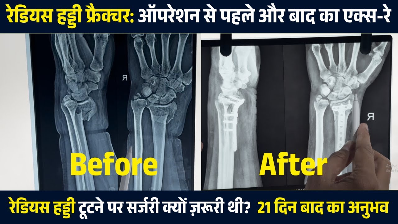 रेडियस हड्डी फ्रैक्चर बिना ऑपरेशन क्या खतरा था पहले-बाद का X-ray और 21 दिन बाद |Radius Bone Fracture