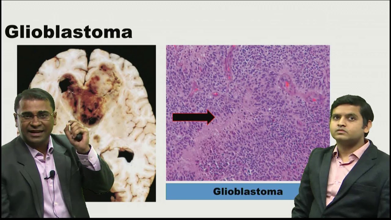 Brain tumor Radio-path Correlation- AIIMS PG PREPARATION