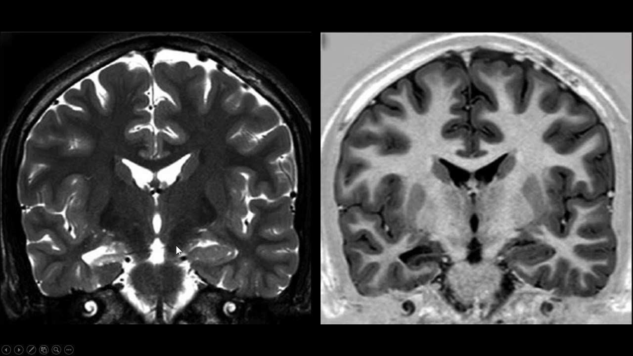Esclerose mesial temporal