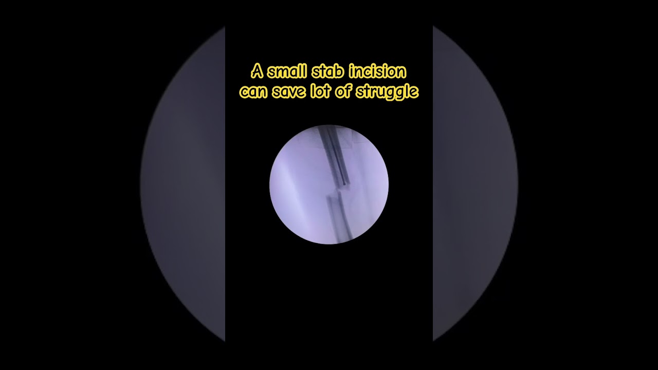 Difficult Reduction in shaft femur fracture? #ortho #trauma #bone #doctor