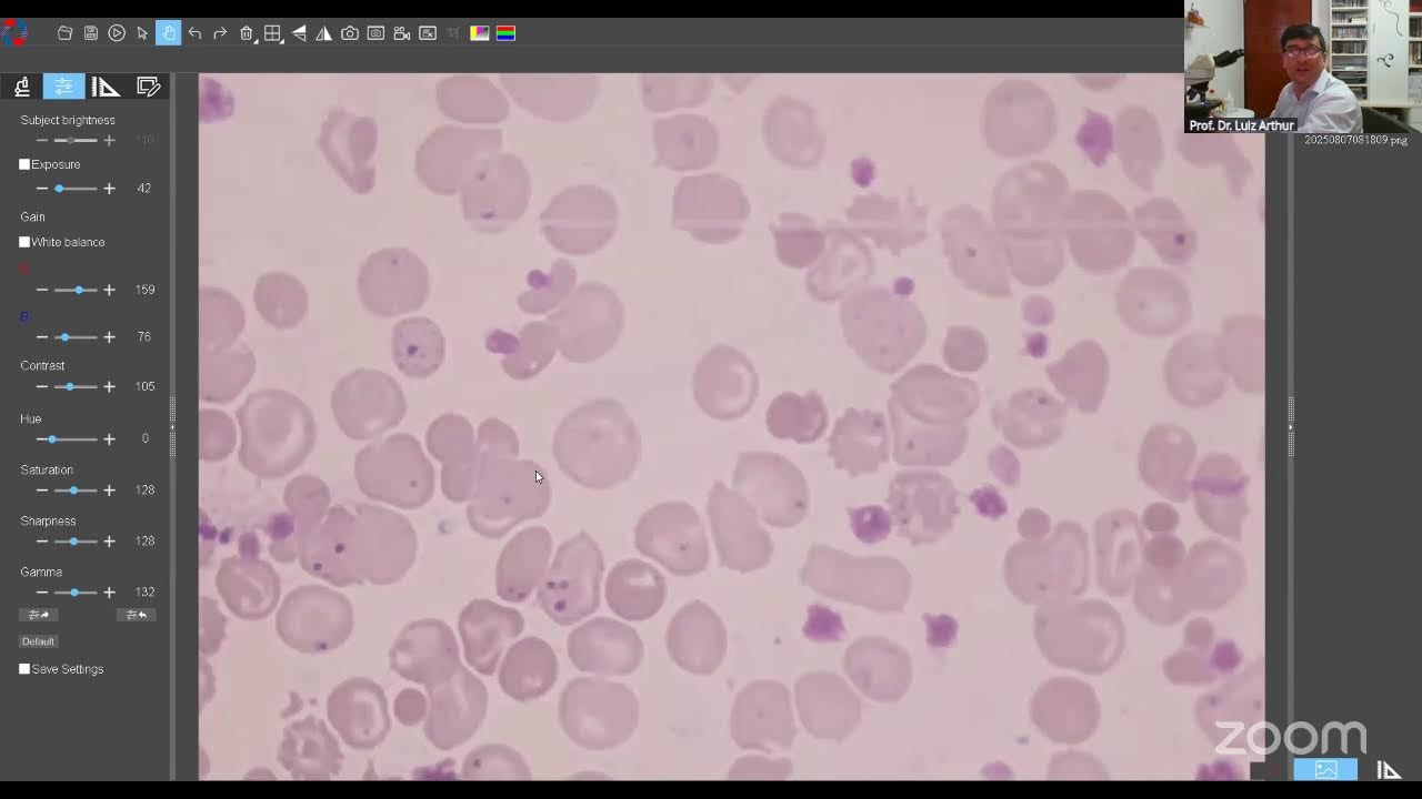 Lâmina de Talassemia -  Prof. Dr. Luiz Arthur