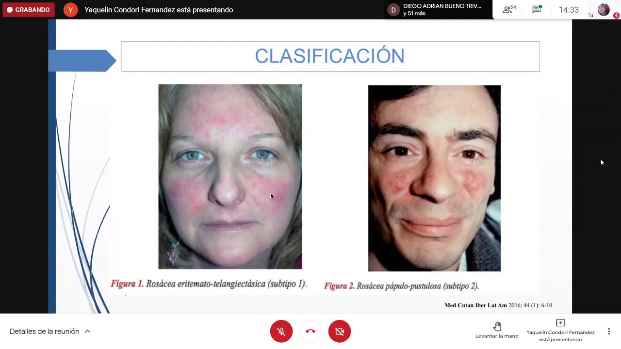 CLASE 3 - DERMATOLOGIA UAC -  ROSÁCEA