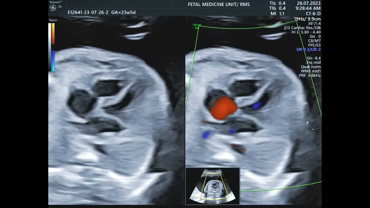 Fetal anomaly detailed scan