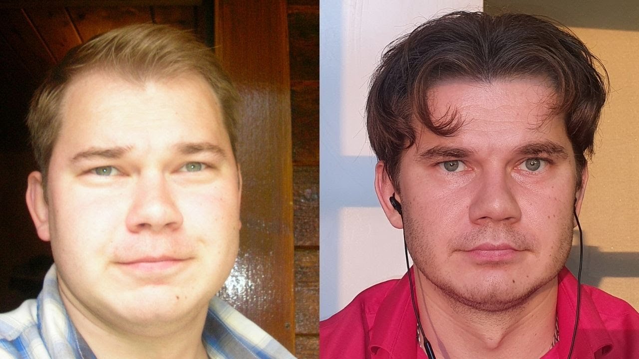 How Much Shedding Should I Expect From Minoxidil Application