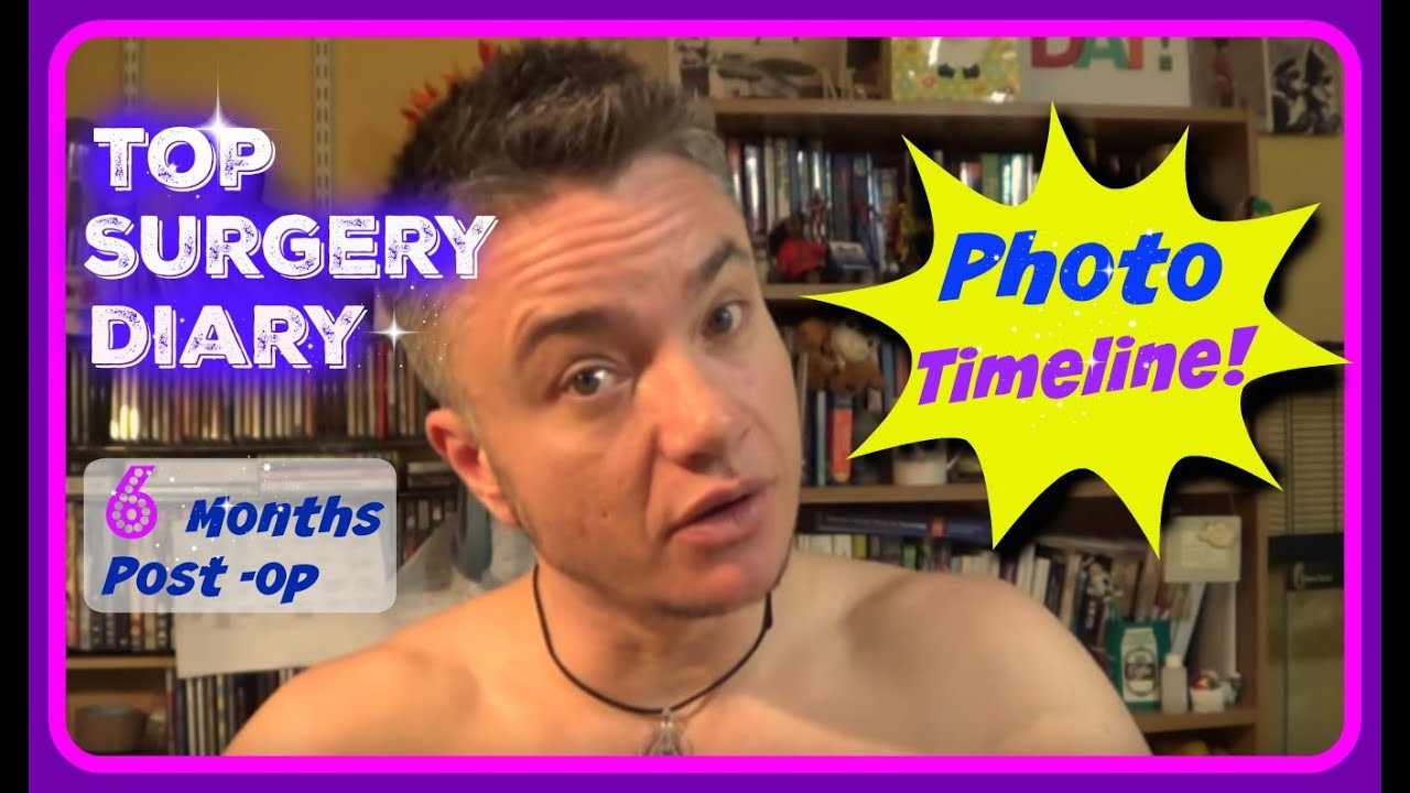 Top Surgery Photo Timeline ( Healing Over 6 Months )