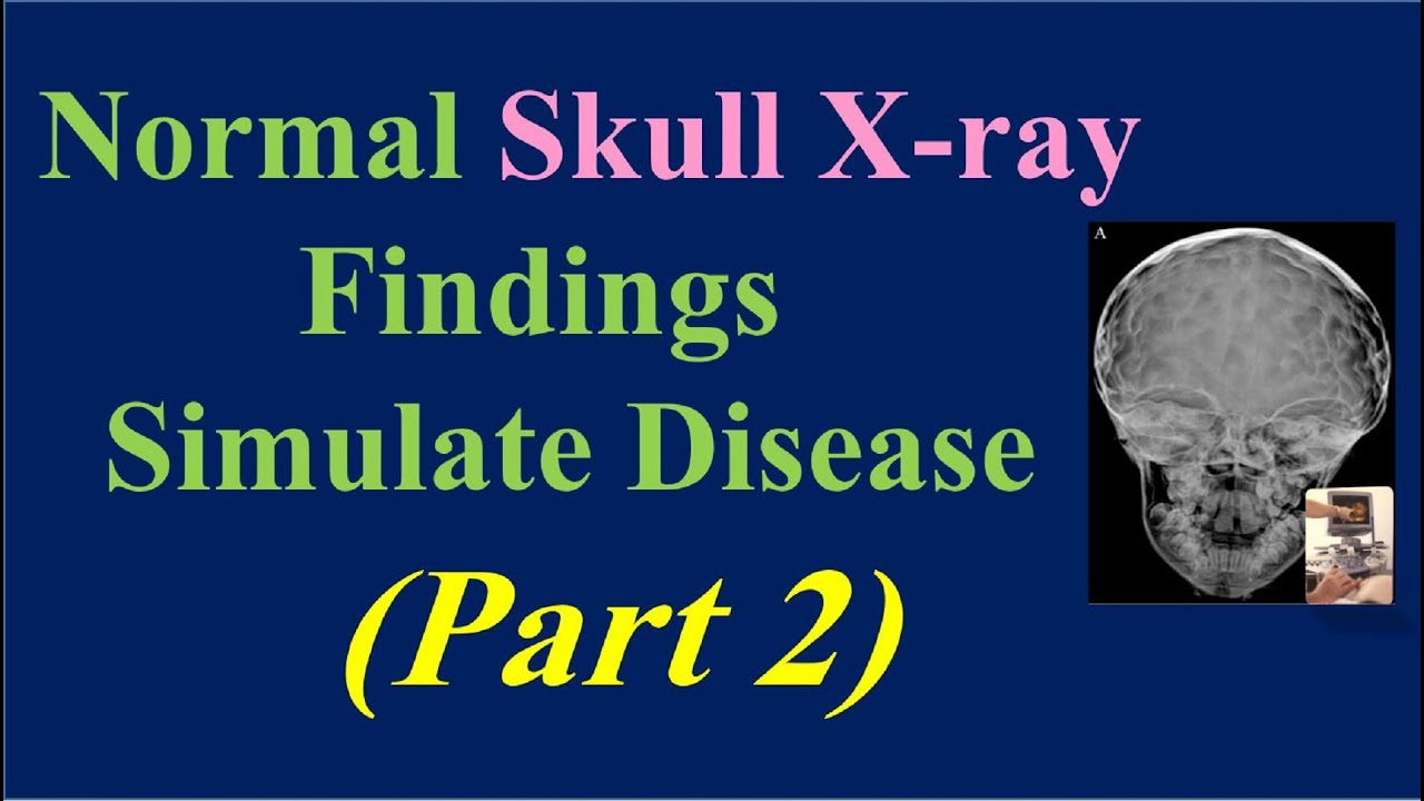 Normal Skull X ray Findings Simulate Disease- part 2