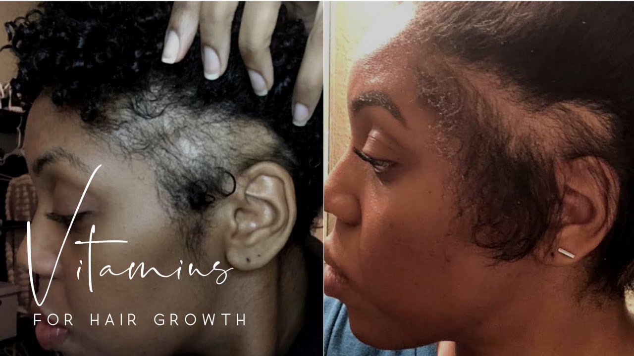 Vitamins for Hair Growth