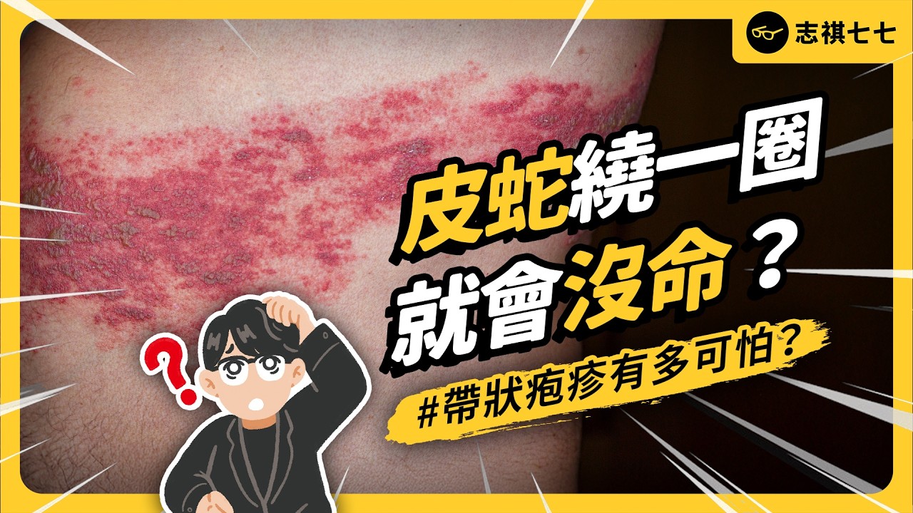 3人中1人！帶狀疱疹為何這麼盛行？該怎麼預防皮蛇？｜志祺七七