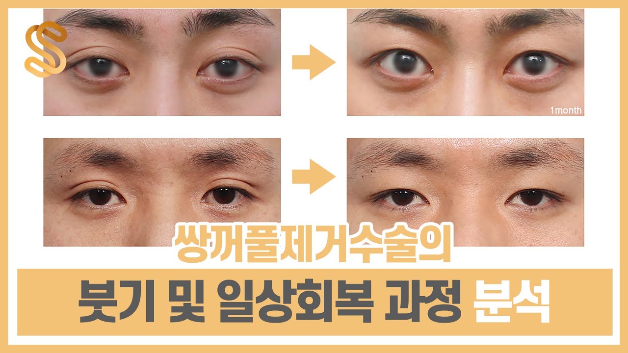 전후사진들로 보는 쌍꺼풀제거수술의 붓기 및 일상회복 과정 #쌍꺼풀없애는수술 #쌍꺼풀푸는수술