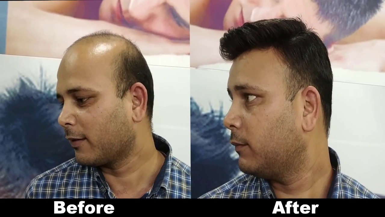 BEFORE & AFTER  a non surgical hair patch system in DELHI & AGRA 8882017181//9582581323