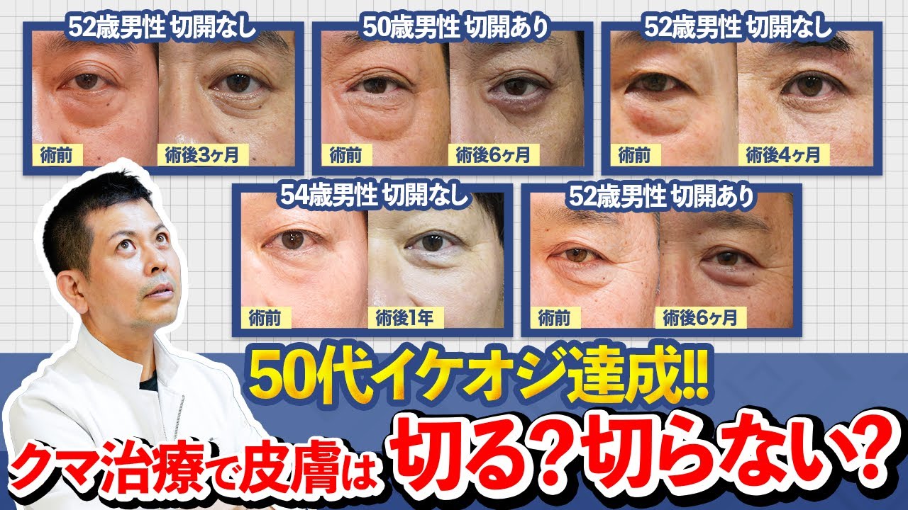 目の下の皮膚は切るべき？50代以降のクマ治療の考え方について徹底解説します【若返り/整形】