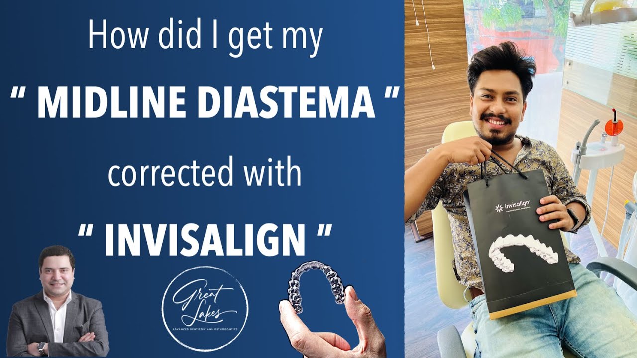 Midline Diastema correction with Invisalign | Invisalign Kolkata  | Treatment for spacing in teeth