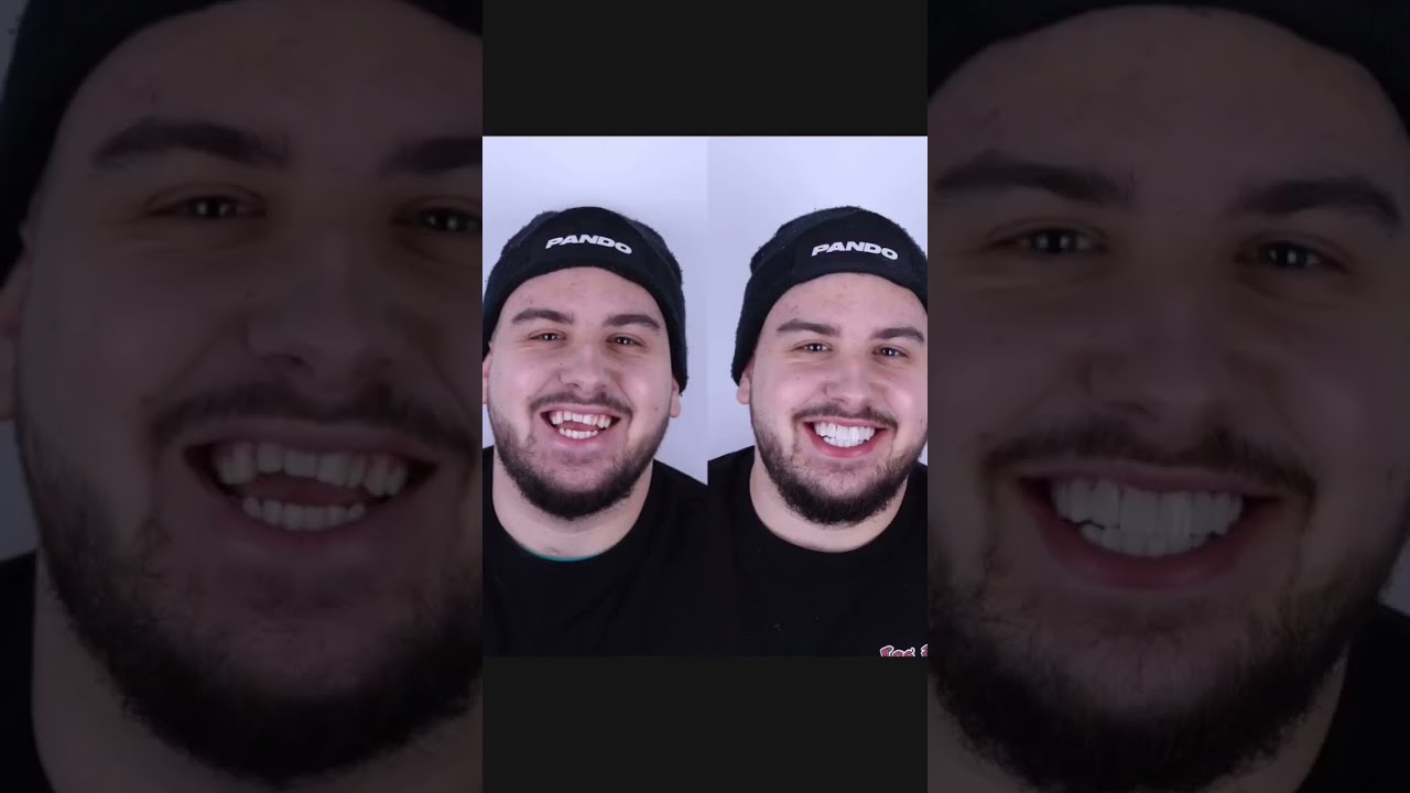 Dental Work in Antalya | Before & After | Dental Transformation in Turkey!