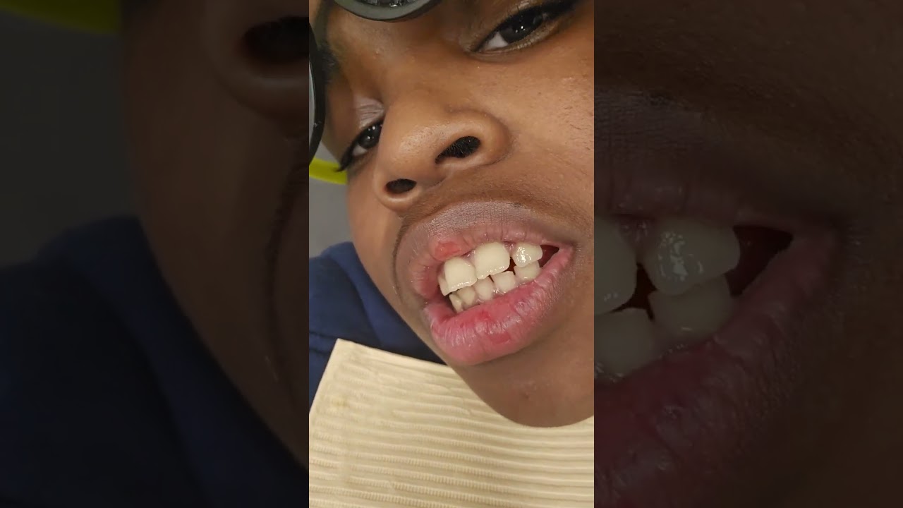 Geting my  teeth done!