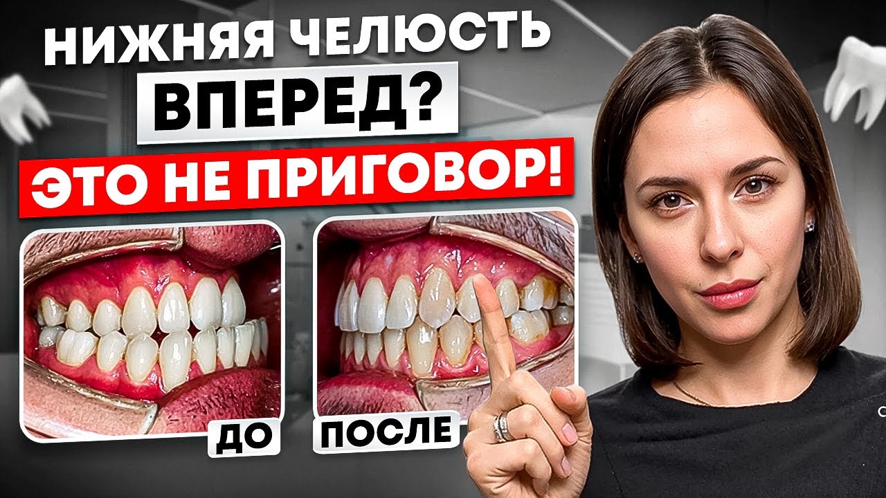 Как исправить мезиальный прикус в 2026 году: Брекеты, мини-винты и операция
