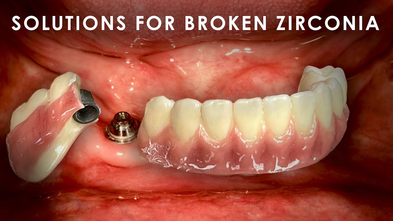 Solutions for Broken Zirconia
