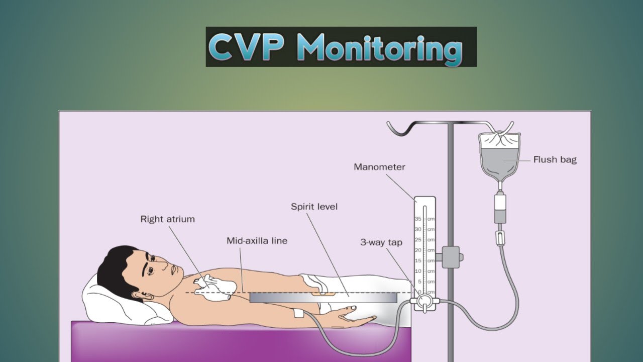 CVP Monitoring | Central venous pressure measurement| How To Measure CVP in Bengali 