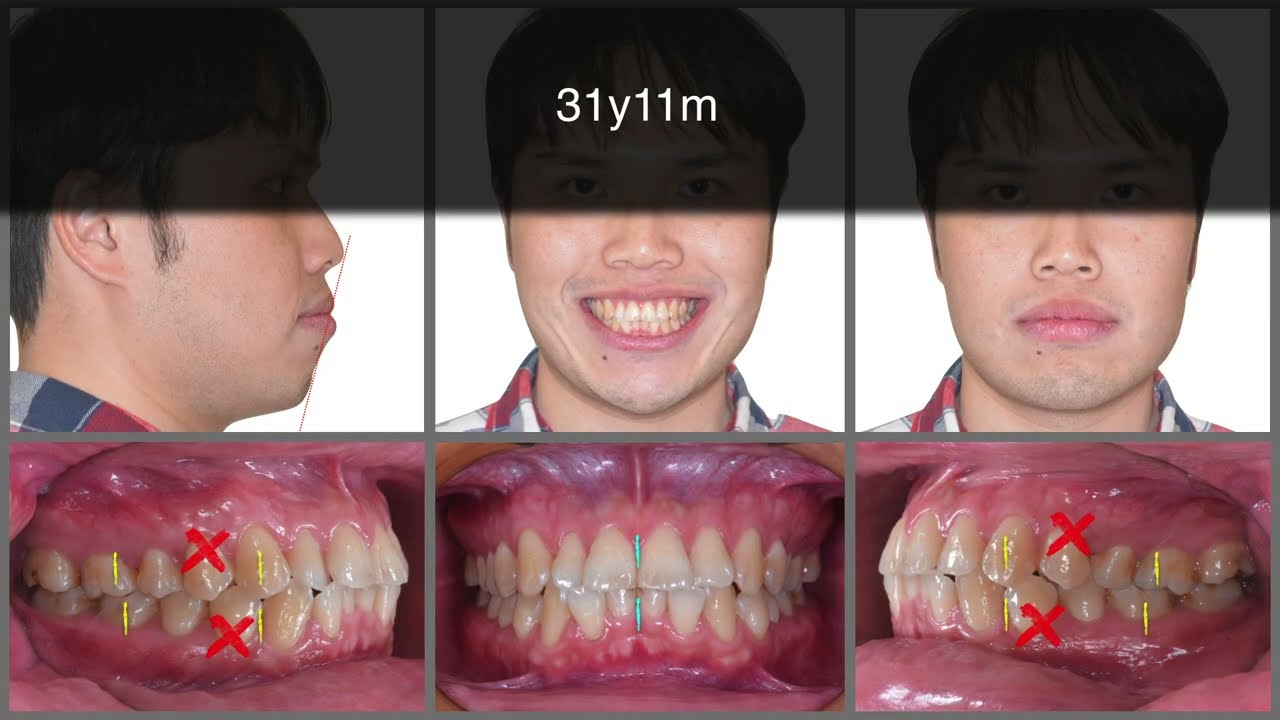 First Premolar Extraction Treatment with Clear Aligners｜【Chris Chang Ortho】CC568