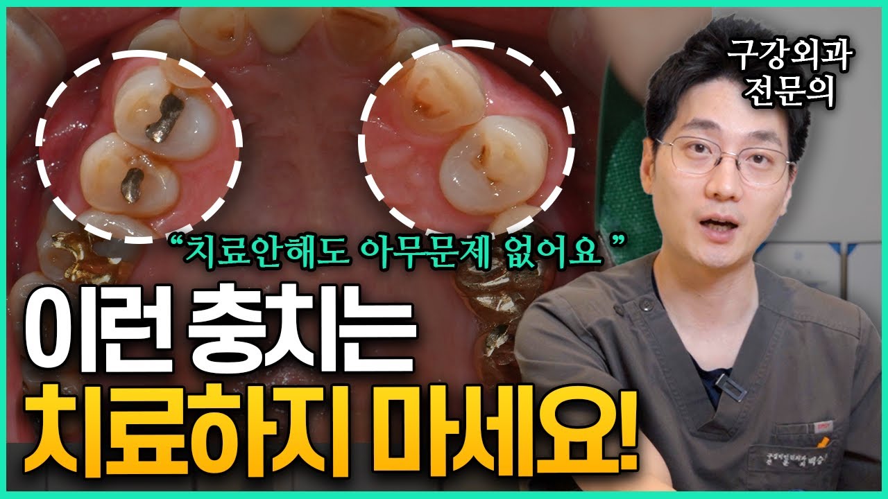 충치치료의 기준! 제대로 알려드립니다! 충치 때문에 고민이신 분들은 보세요