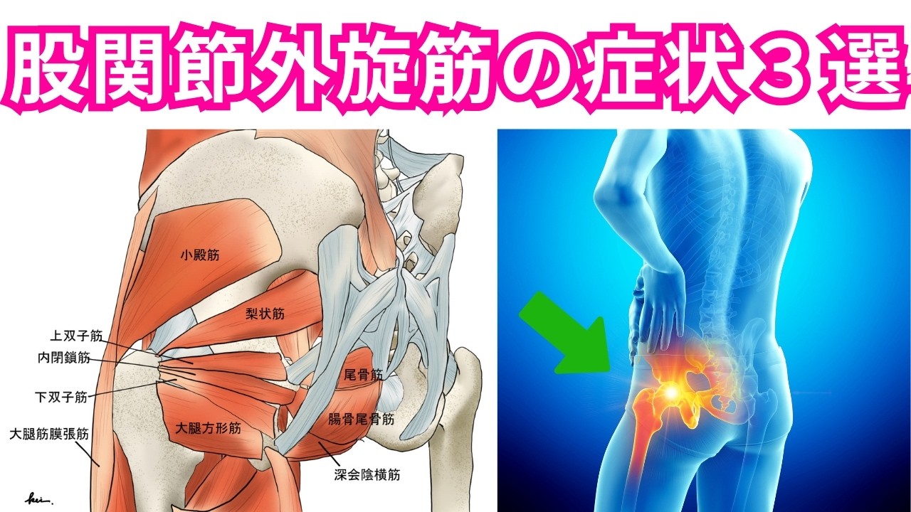 「股関節外旋筋の固さ」によって起きる臨床的に多い症状３選！