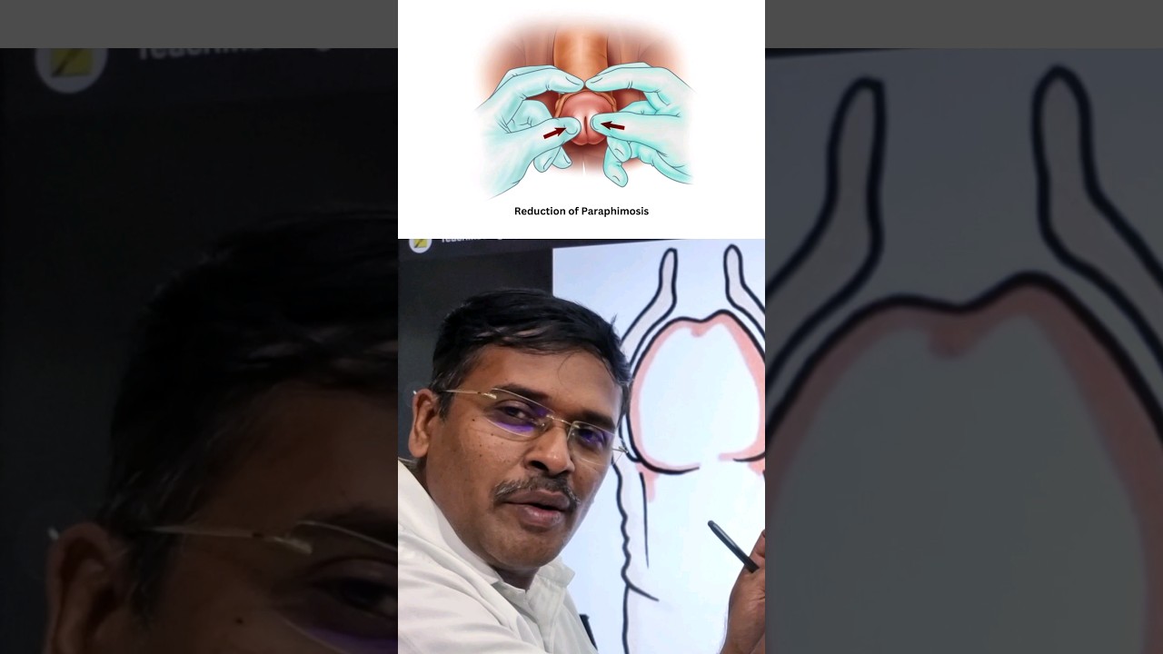 ஆண்குறி முன் தோல் பிரச்சினைகள் !? #doctorkarthikeyan