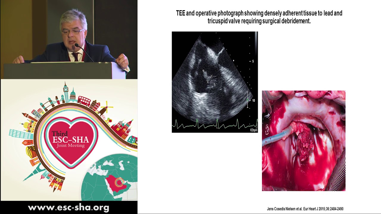 ESC-SHA - Update in Pocket Infection Management and Pacemaker Lead Extraction