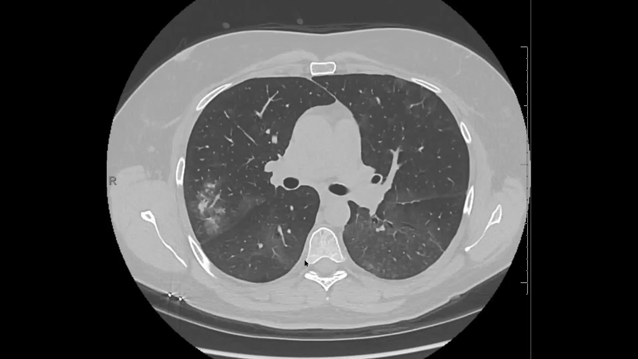 Natural evolution of organizing pneumonia secondary to immunotherapy.