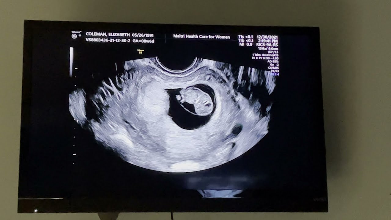 Surprise ultrasound!