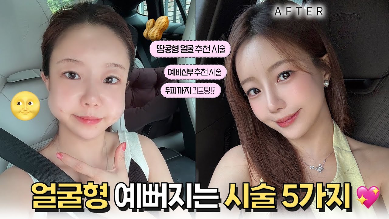 시술로 차 한대 값 태움🔥3탄 얼굴형이 예뻐지고 작아지는 시술 (두피 리프팅 | 땅콩형 얼굴 | 온다 리프팅 | 배우들이 촬영 전 하는 시술 | 지방 줄기세포 후기)