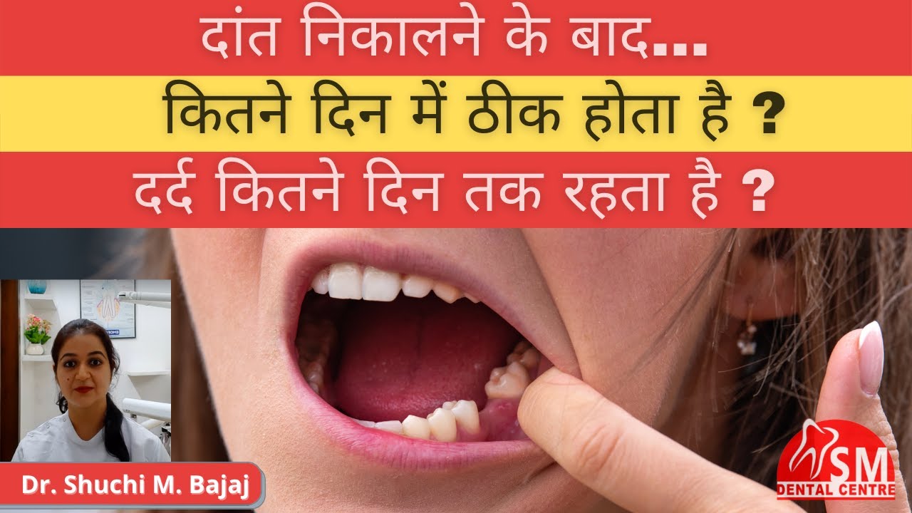 दांत निकालने के बाद कितने दिन में ठीक होता है? | अकल दाढ़ का दर्द कितने दिन तक रहता है | Dr. Shuchi